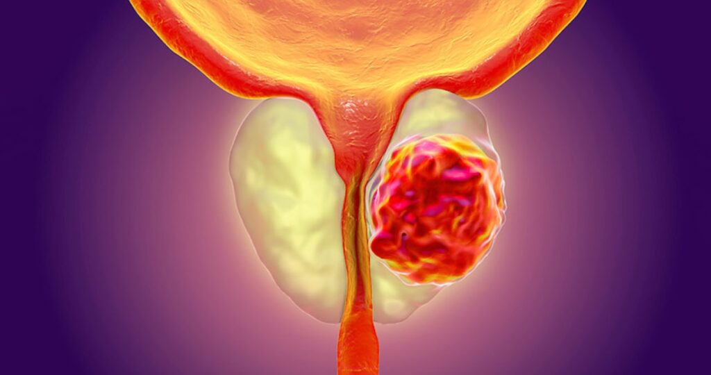 petct bg rak na prostata diagnostika