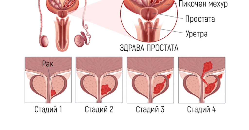 Колостома 7