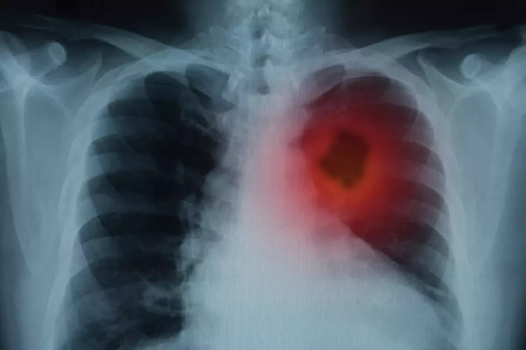 Скрининг и ранно откриване на рак на белия дроб lungs cancer rak