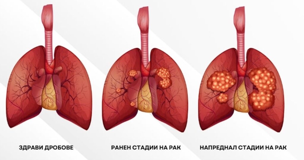 Стадии на рак на белия дроб Инфографика на бял дроб статии рак на дроб бял СЪСТОЯНИЕ